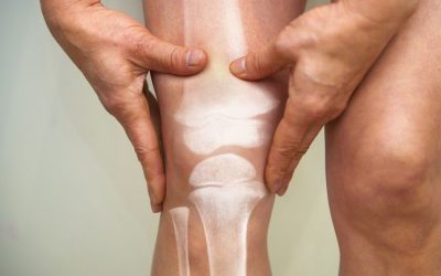 Osteoporosis: factores de riesgo y tratamientos para prevenirla.